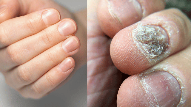 healthy nail vs fungal nails