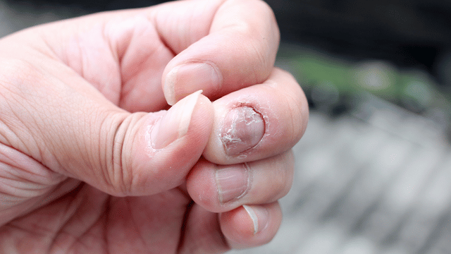 White nails compared to healthy pink nails